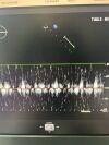 PHILIPS X5-1 Ultrasound Transducer