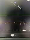 PHILIPS X5-1 Ultrasound Transducer