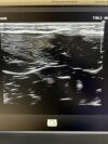 PHILIPS L12-3 Ultrasound Transducer
