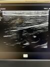 PHILIPS L12-3 Ultrasound Transducer