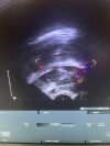 B&K 8808e Ultrasound - Urology
