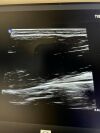 PHILIPS L12-3 Ultrasound Transducer