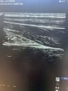 GE ML6-15-D Ultrasound Transducer