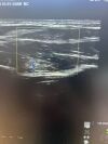 GE ML6-15-D Ultrasound Transducer