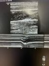 GE 9L-D Ultrasound Transducer