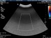PHILIPS C92 Ultrasound Transducer