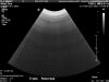 PHILIPS C92 Ultrasound Transducer