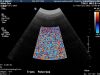 PHILIPS C92 Ultrasound Transducer
