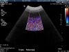 PHILIPS C92 Ultrasound Transducer