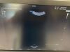 SAMSUNG Hera W9 Ultrasound