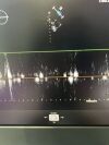 PHILIPS X5-1 Ultrasound Transducer