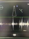 PHILIPS X5-1 Ultrasound Transducer