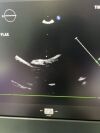 PHILIPS X5-1 Ultrasound Transducer