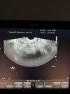PHILIPS C8-4V Ultrasound Transducer