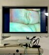 STRYKER 1288 HD System Laparoscope