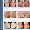 AGEJET  USA Non-Invasive Laser Treatment for Skin Rejuvenation Tightening Resurfacing Best Oxygen Jet Product Laser - Radio Frequency (