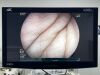 FUJINON Scope  Model: EC-600WM Colonoscope