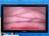 KARL STORZ Tower Laparoscope