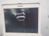 PHILIPS CX50 Ultrasound - Cardiac