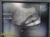 SIEMENS/ACUSON 2011 Siemens 4C1 Convex Array Probe, P/N 08259644 ~ Ultrasound Transducer
