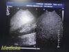 PHILIPS IU-22 S4-1 Phased Array Ultrasound Probe 4000-0966-02 (TESTED) / Ultrasound Transducer