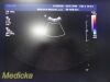 PHILIPS IU-22 S4-1 Phased Array Ultrasound Probe 4000-0966-02 (TESTED) / Ultrasound Transducer
