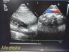 PHILIPS S5-1 P/N 21314A Sector Array Ultrasound Transducer