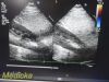 PHILIPS S5-1 P/N 21314A Sector Array Ultrasound Transducer