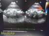 PHILIPS S5-1 P/N 21314A Sector Array Ultrasound Transducer