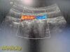 SIEMENS/ACUSON 2013 Siemens 4C1 Convex Array Ultrasound Transducer