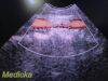 PHILIPS IU-22 S4-1 Sector Array Ultrasound Probe 4000-0966-02 (TESTED)/ Ultrasound Transducer