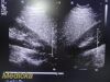 PHILIPS IU-22 S4-1 Sector Array Ultrasound Probe 4000-0966-02 (TESTED)/ Ultrasound Transducer
