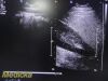 PHILIPS IU-22 S4-1 Sector Array Ultrasound Probe 4000-0966-02 (TESTED)/ Ultrasound Transducer