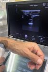 GE VOULSON E10 Ultrasound Transducer