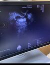 GE VOULSON E10 Ultrasound Transducer