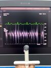 PHILIPS EPIQ 7C, YOM: 2016 with Probe  X5-1 Ultrasound