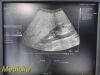 SIEMENS/ACUSON 2005 Siemens 4C1 Convex Array Ultrasound Transducer