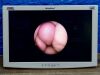 KARL STORZ Scope Model: 11272C1 Cystoscope Lot: 177 Laparoscope