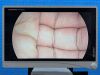 STRYKER 1488 Laparoscopy Processor YOM: 2017 Laparoscope