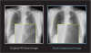 Bone Suppression Imaging by Konica Minolta Healthcare Americas