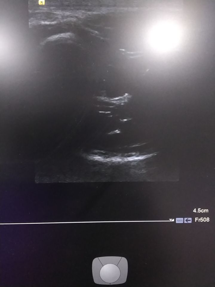 SIEMENS ACUSON S1000 Diagnostic Ultrasound System