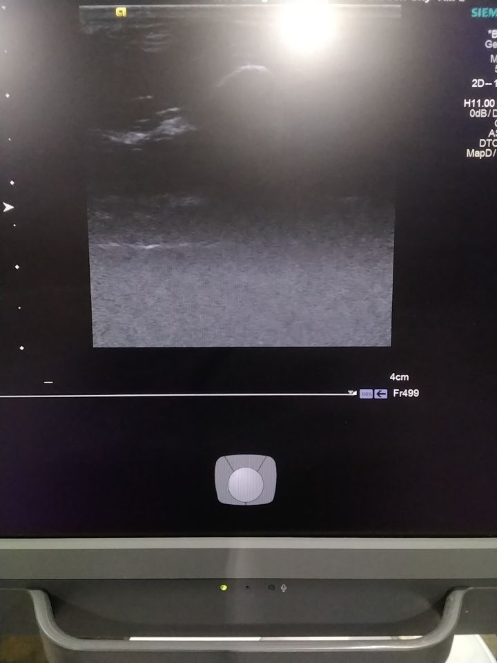 SIEMENS Acuson 14L5 Ultrasound Transducer