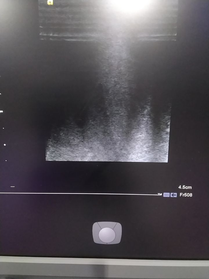 SIEMENS Acuson 9L4 Ultrasound Transducer