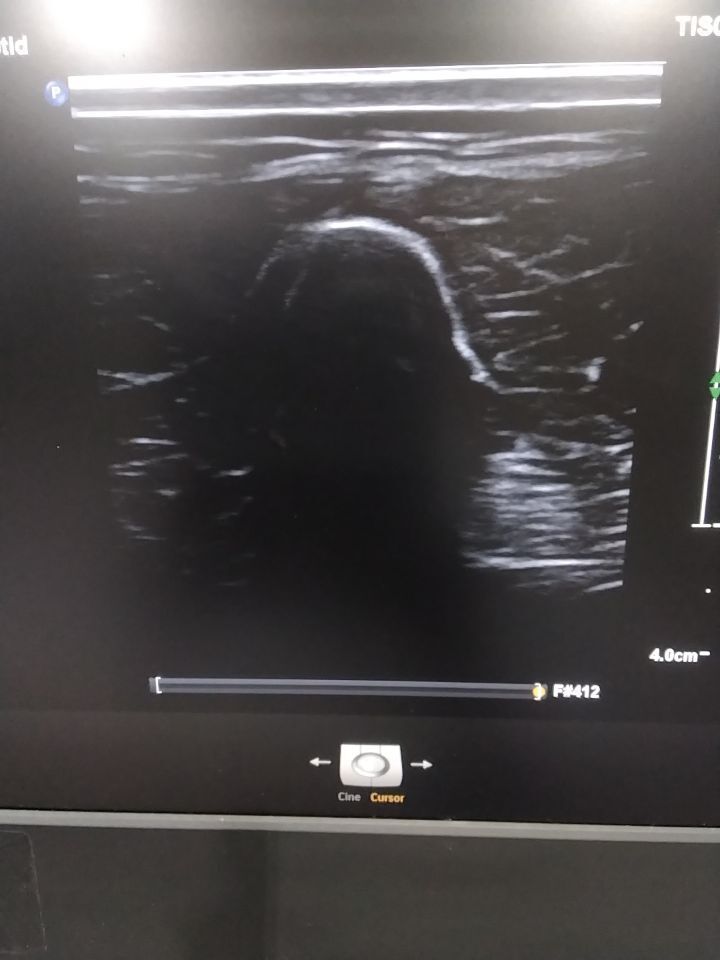 PHILIPS L12-3 Ultrasound Transducer