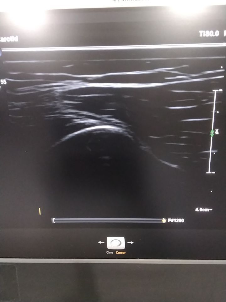 PHILIPS L12-5 50 Ultrasound Transducer