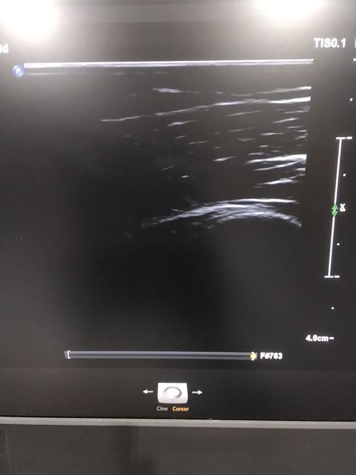 PHILIPS L18-5 Ultrasound Probe Ultrasound Transducer
