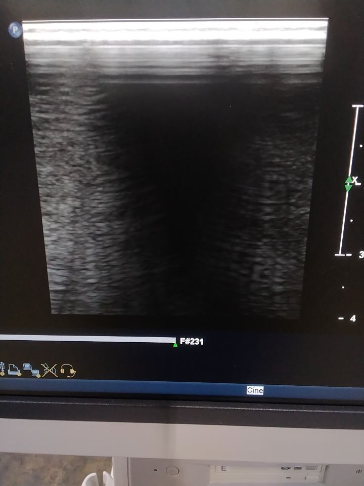 PHILIPS iU22 Diagnostic Ultrasound System
