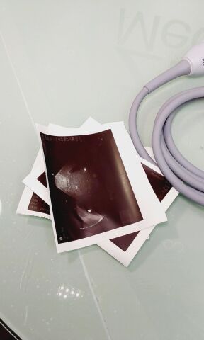 SONOSITE P21X/5-1 Ultrasound Transducer