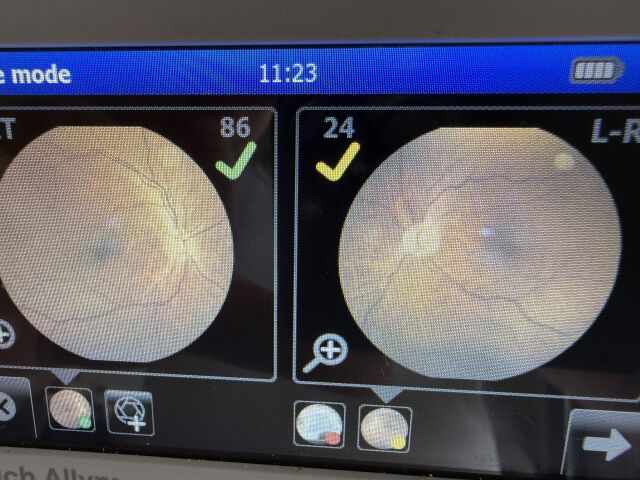 WELCH ALLYN RetinaVue 700 Imager RV700 Fundus Camera