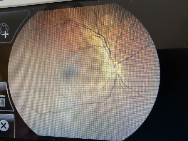 WELCH ALLYN RetinaVue 700 Imager RV700 Fundus Camera
